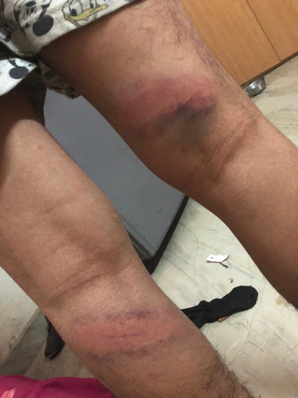 Bruises on the legs of the Tibetan youth who was thrashed by a policeman in Delhi's Mahipalpur.
